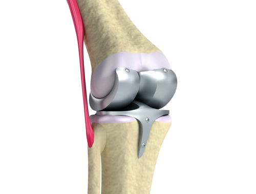 Knee Replacement Surgery: Before and After