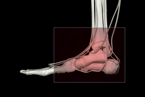 Individual Solution Key to Repairing a Torn Achilles Tendon