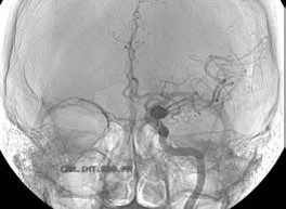 Treating a Brain Aneurysm with Coiling