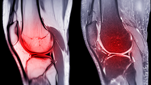 acl surgery