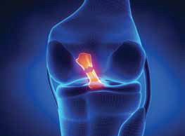 ACL Repair: Your Tissue or Someone Else’s?