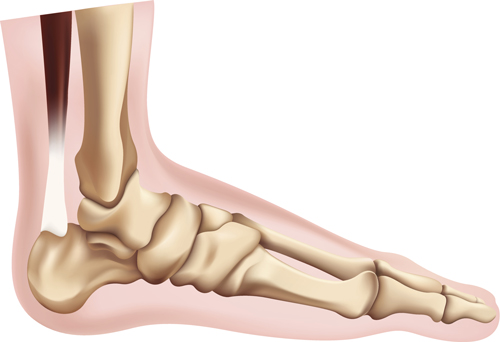 Ankle Sprains: Not All Are Created Equal