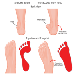 Runners foot pain caused by too much pronation.