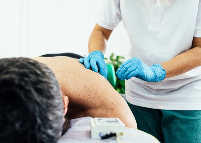 what is dry needling